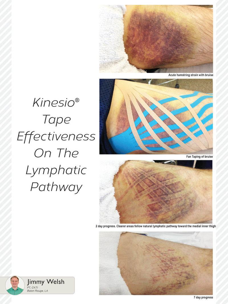 Load image into Gallery viewer, Kinesio® Classic Fan Cut Tape