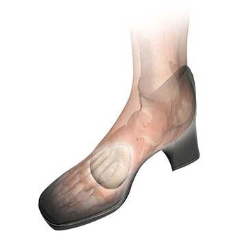 Hapad® Metatarsal Cookies